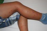 Bed Bugs In My Hotel: Is That A Personal Injury Claim?
